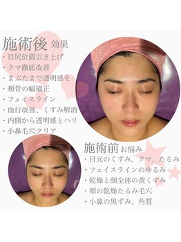 ライゼ(REISE)/ビフォーアフターご紹介【毛穴】