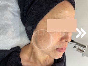 グリーンピール エルモナ(GREENPEEL ELMONA)/【グリーンピールレスベラ】