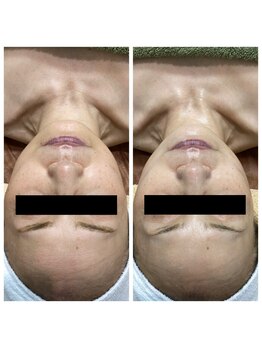 ランプ(LAMP)/~BBL光フェイシャル~