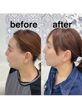 ハロ 南青山(HALO)/【小顔フェイシャル】2回目