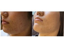 なごみ/肌質改善【ハーブピーリング】