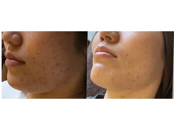 なごみ/肌質改善【ハーブピーリング】