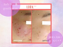 チャパン(Chapan)/韓国すっぴん美人＆毛穴ケア専門