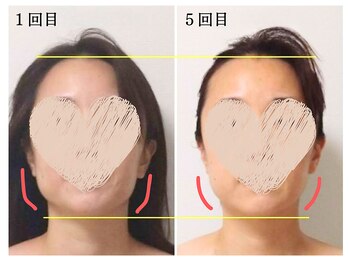 ミレア(Milea)/フェイスラインがシャープに！