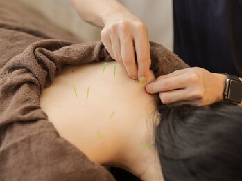 美療鍼灸整骨院/ハリ施術