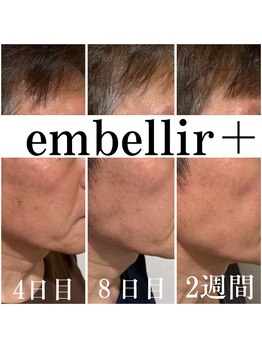 アンベリールプラス(embellir+)/男性もお勧め!光フォト