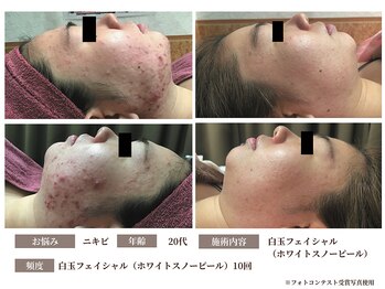 グラシーズ(Glasses)/白玉フェイシャル・スノーピール