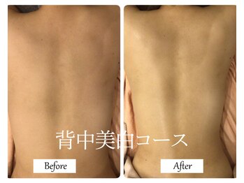 リノ(Lino)/背中美白コース♪