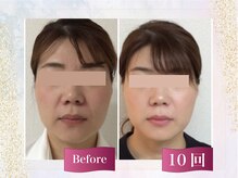 【ほうれい線】40代女性×笑わなくても出現する嫌～な線