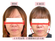 アドレル(Adorer)の雰囲気（痛みの少ない施術で続けやすいと評判いただいております★/小顔）