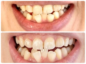 クロワ(croix)/ホワイトニング初回/透明感UP