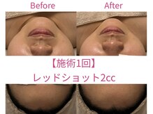 マスカレード 品川(Masquerade)/Red Shot小顔