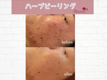 ブランリス(Blanclis)/REVIハーブ　ビフォーアフター