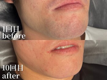 ボス 名古屋店(BOSS)/【ヒゲ脱毛　before & after】