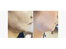 メディカルエステ アンボーテ/レモンボトル施術