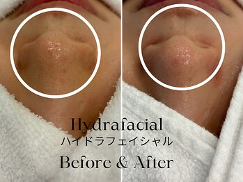 トウキョウビューティーラボ(TOKYO BEAUTY LABO.)/ハイドラBefore&After