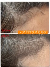 ニューユー(NewYou)/ノアグロウスカルプ