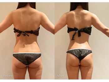 シューラディアント(ShuRadiant)の写真/【とことん全身ダイエット☆】体重増加&ボディラインの崩れを徹底改善!!頑固なセル脂肪を分解&燃焼！