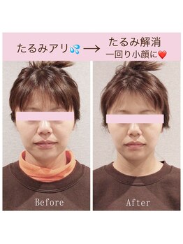 ビーホリック(Bholic)/一回り小顔、肌のハリUP