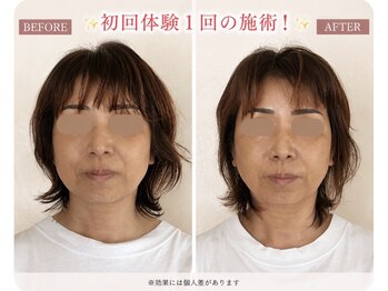 リフェイス(RE:FACE)/初回体験ビフォーアフター