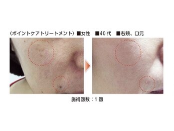 美Rの写真/【韓国発シミケア×日本発シミケア】剥がせる！話題のホワイトラボもOPEN記念価格でお得に体験♪
