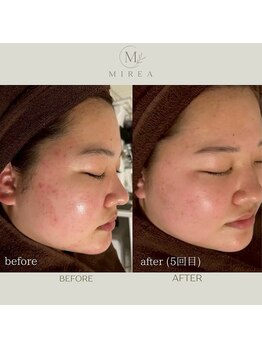 ミレア 恵比寿(MIREA)の写真/【ハリツヤUP】気になる肌のたるみやシワを徹底ケア！内側から輝くような弾力と潤いのある美肌へ◎
