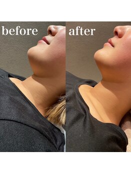 アイスタイル(i-style)/脂肪冷却/痩身ダイエット/泉大津