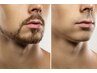 【men’s★脱毛】めんどくさいを無くしませんか？ヒゲ脱毛
