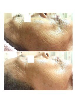 アモリアージュ(Amolliage)/しわ改善