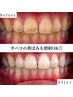 【喫煙者の方にオススメ☆】美白セルフホワイトニング40分照射¥3300
