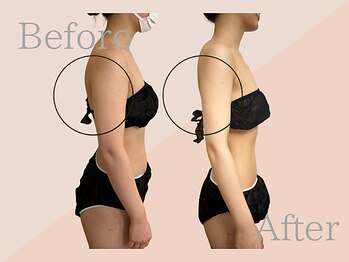 ファミーユ 名古屋店/【ブライダル】二の腕やせ