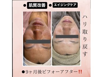 イアリイ/肌質改善スキンケアコース