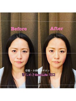きらめき ワンライフ 川口(One Life)/小顔矯正BeforeAfter8