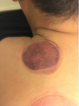 足もみサロン ループ(LOOP)/カッピングをした後