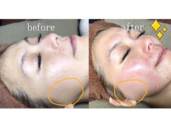 カルーナ 住吉店/お顔のワックス脱毛でピカピカ☆