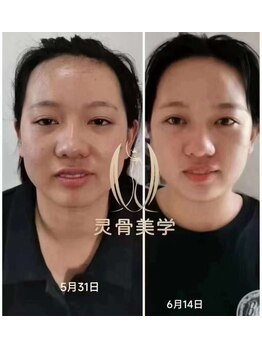 ユーキュウ(yu.9)/小顔矯正★施術効果