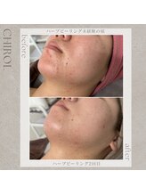チロル(CHIROL)/肌荒れやニキビケアに☆