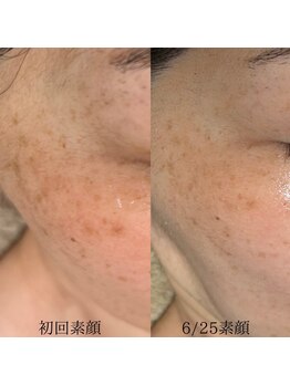 サロン ド エン(Salon de. en)/しみケア◇ハーブピーリング