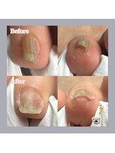 巻き爪補正店 天王寺店/小さいお爪の巻き爪