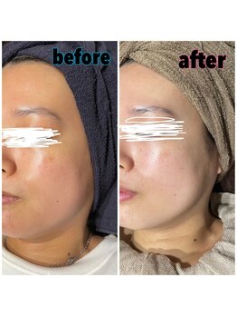 アースコアフュールボーテ 小山店(EARTH coiffure beaute)/光フェイシャル/光フォト