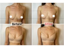 ロットプラス(Lot Plus)/Before→After（約2ヶ月の変化）