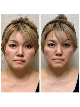 ドクターコガオ 福山店(Dr.小顔)/☆施術1回での変化☆