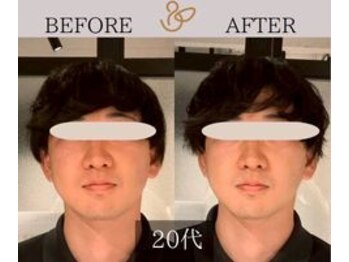 チョコバリ 新宿店(chocobari)/小顔×リフトアップ(美容鍼)20代