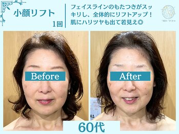 フローフシ∞/【小顔】切らない小顔リフト