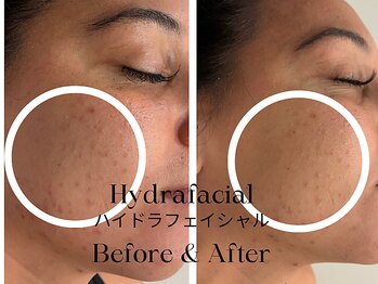トウキョウビューティーラボ(TOKYO BEAUTY LABO.)/ハイドラBefore&After