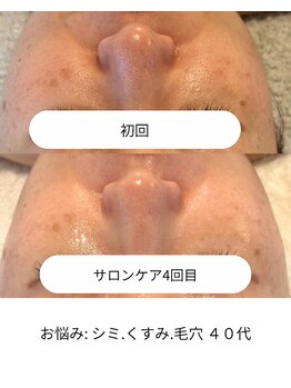 リンクアンドボーテ 大垣(Link&Beaute)/エイジングケア シミ.くすみ毛穴