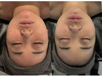 ファブ(Fab)の写真/【人気No.1小顔コルギ¥4,400】痛みが少ないのにしっかり効果あり◎デコルテマッサージやヘッドスパ追加OK◎