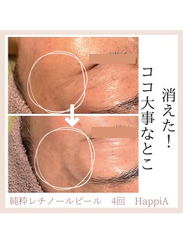 ハピア(HappiA)/純粋レチノールピール