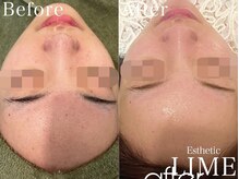 ライム 心斎橋(LIME)/ ハーブピーリング｜毛穴/ニキビ