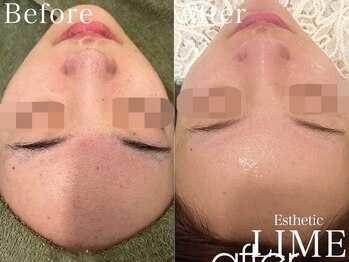 ライム 心斎橋(LIME)/ ハーブピーリング｜毛穴/ニキビ